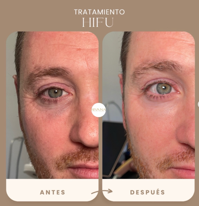 HIFU Mirada