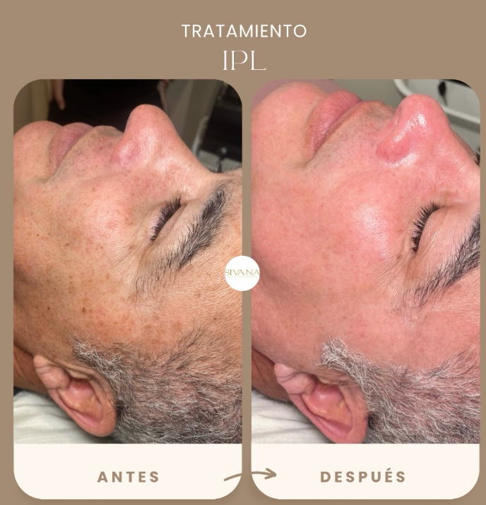 Tratamiento del Acné con IPL
